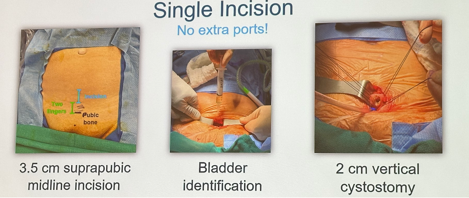 7_single_incision.png