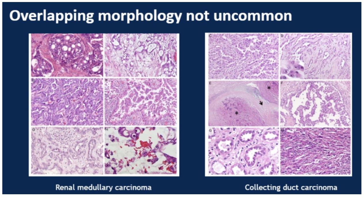 ASCO GU 2020 patho study 1 overlapping morphology