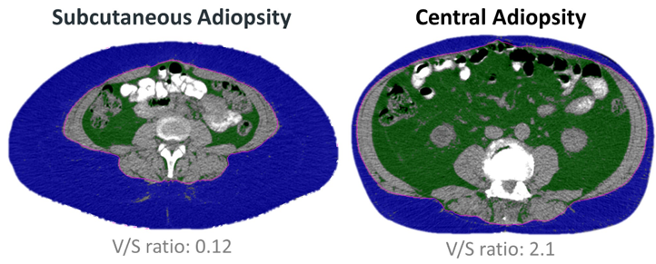 ASCO_body_mass_index_BMI.png