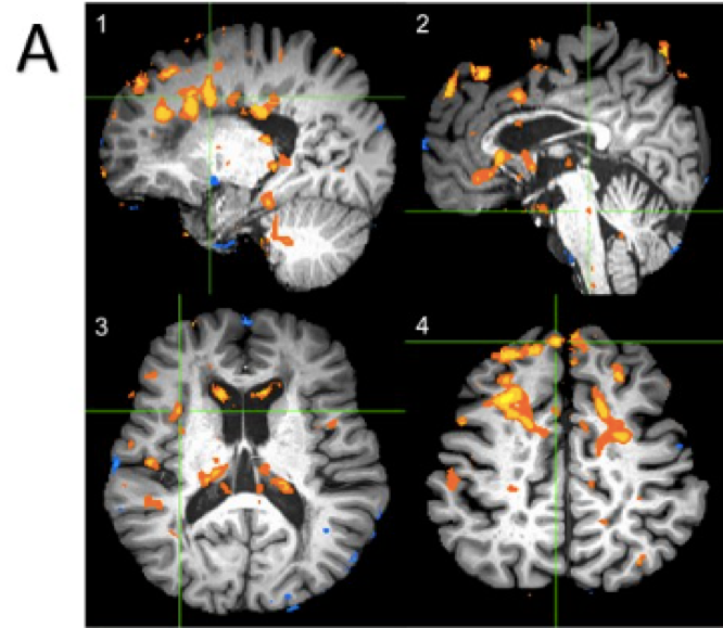 UroToday_AUA2018_Changes in Brain Activity_1