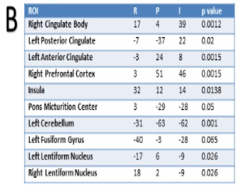 UroToday_AUA2018_Changes in Brain Activity 2a