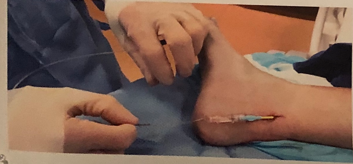 Chronic_tibial_nerve_stimulation_demonstration.png