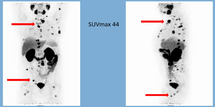 EAU2020_PSMA-targeted_Radioligand_Therapy_2.png