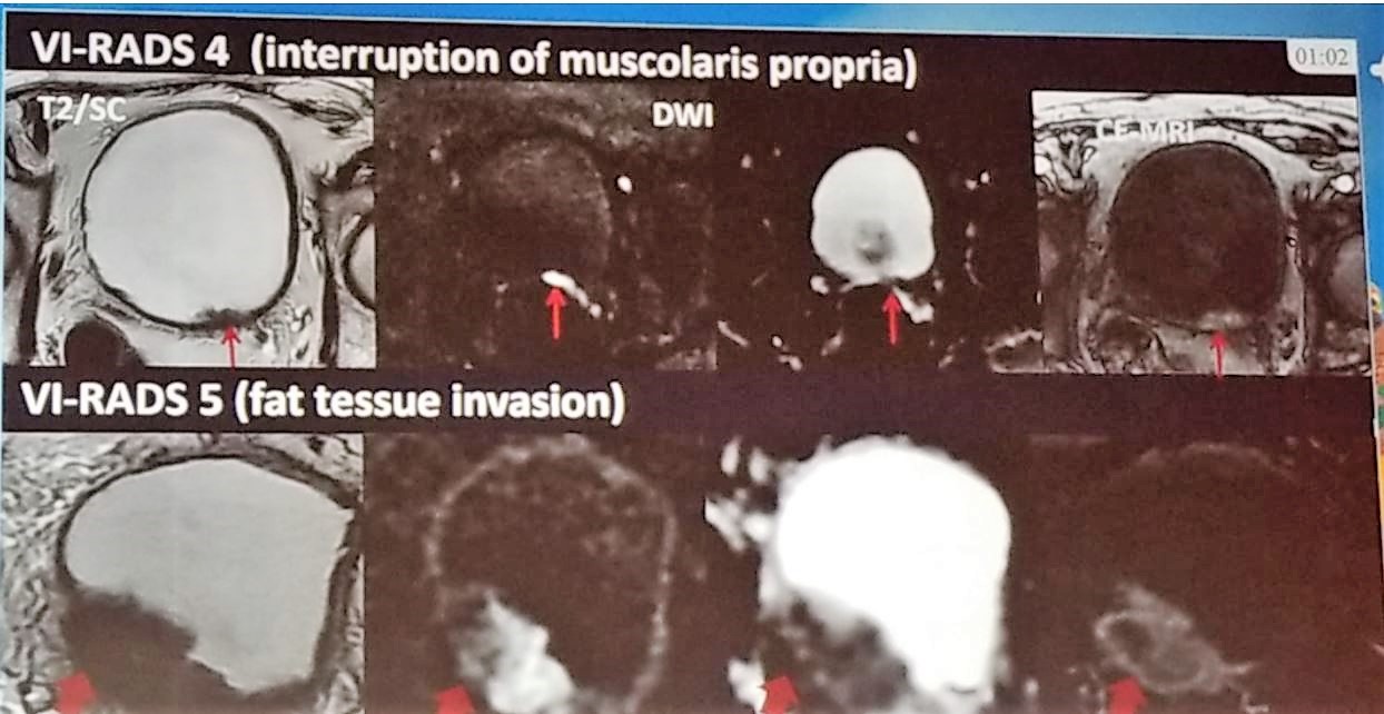 EAU 2019 VIRADS score 45