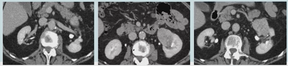 ESOU_Renal_Cancer.png