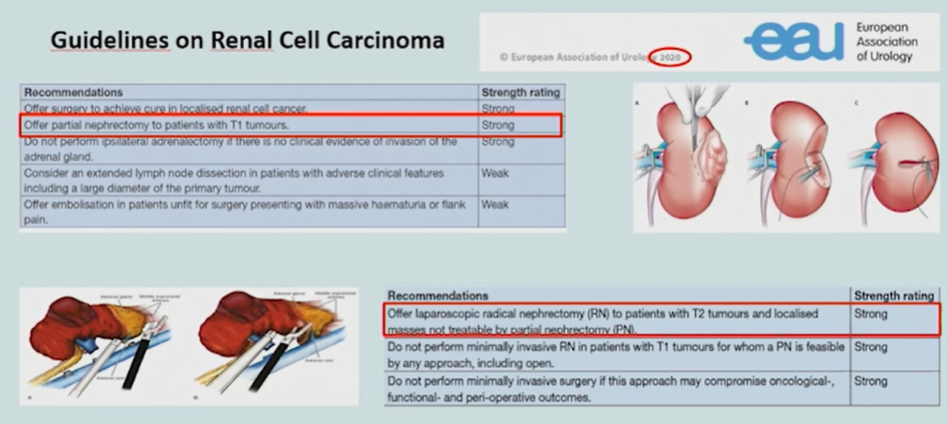 ESOU_partial_nephrectomy.png