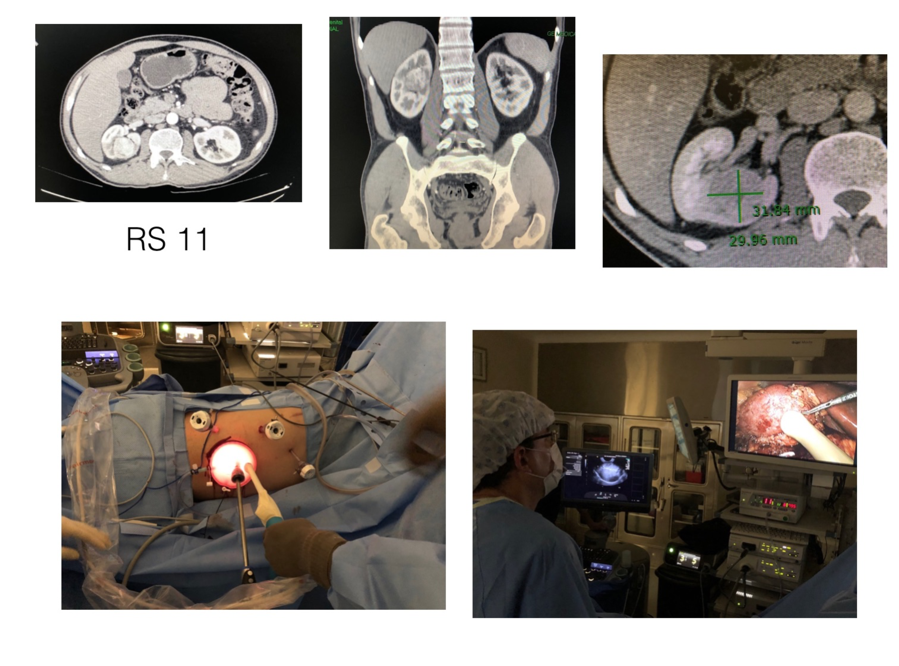 Figure1_NephronSparingSurgery.png