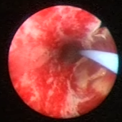 Grade3injury.png