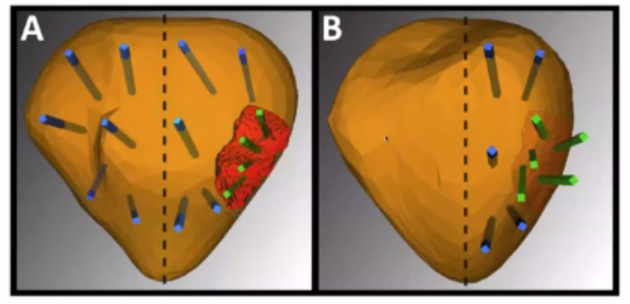Hu_Prostate_Biopsy_Ablation.png