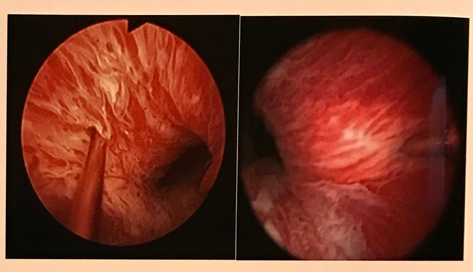 UroToday_AUA2018_OnabotulinumtoxinA injection to the external urethral sphincter