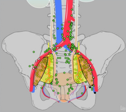 PelvicLymphNode_MetastaticPCa.png