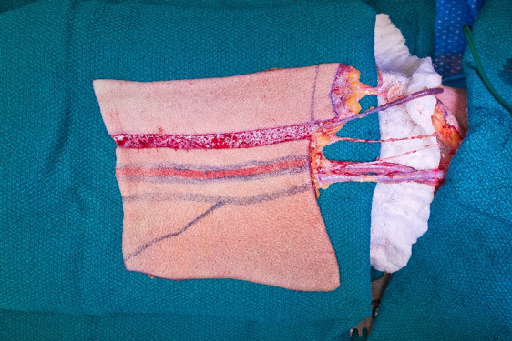 Radial_Forearm_flap.png