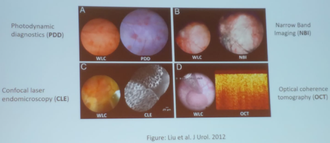 Recommended enhanced imaging in cystoscopy