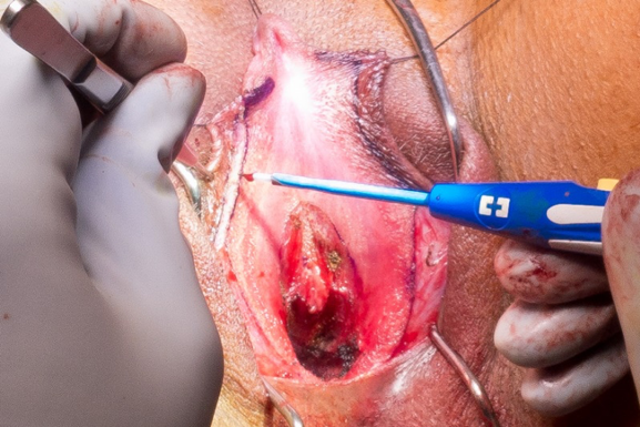 Ring_Flap_dissection.png