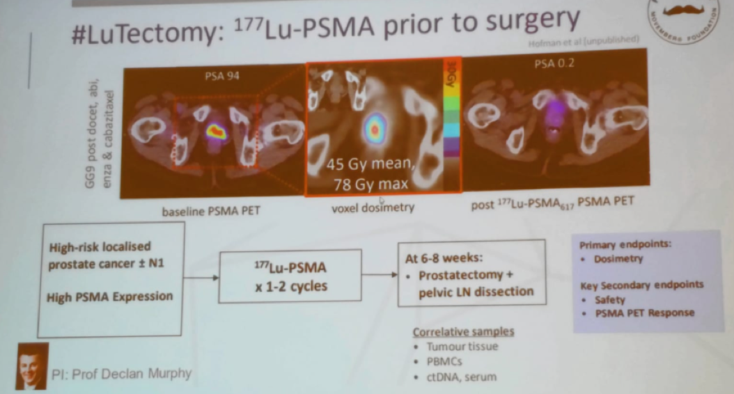 SIU19_LUTECTOMY_trial.png