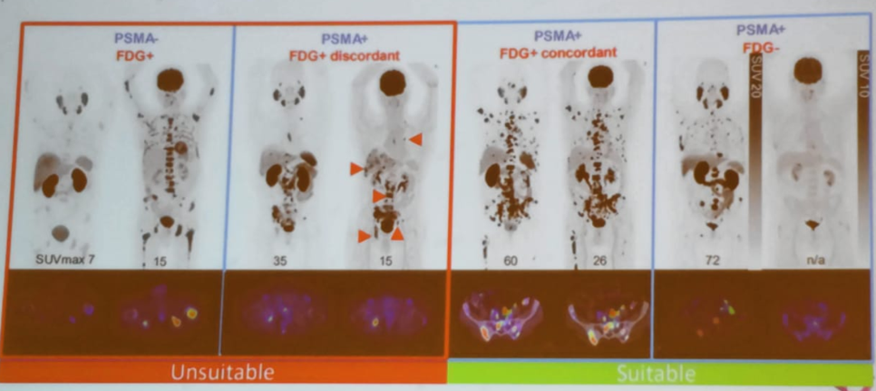 SIU19_Lu-PSMA_treatment.png