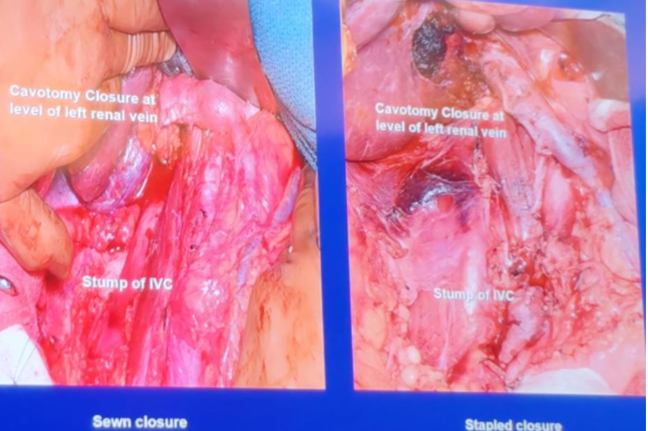 SIU 2019 Cavotomy closure technique