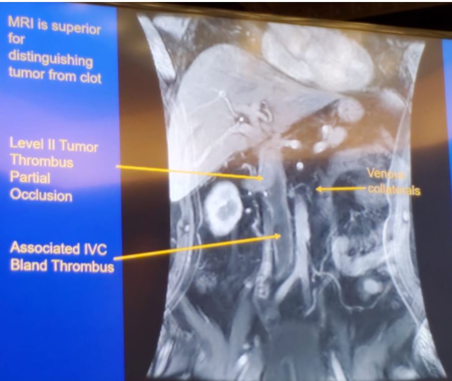 SIU 2019 MRI thrombus and bland thrombus