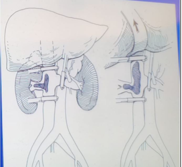 SIU 2019 Tumor thrombus level 1 or 2 treatment