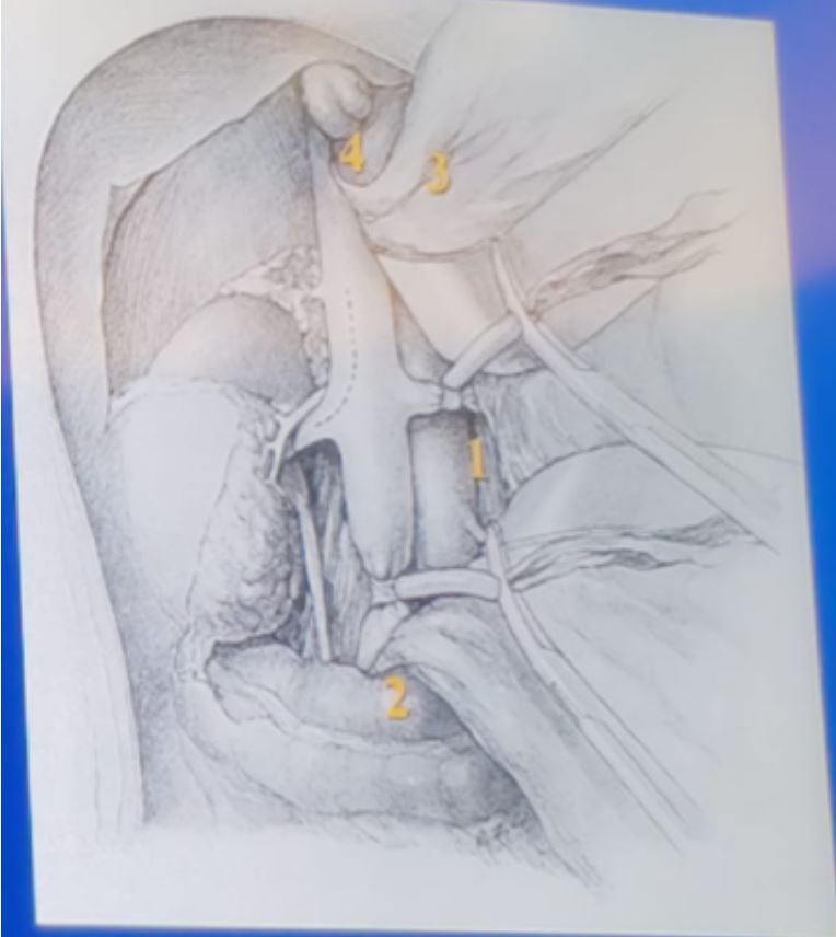 SIU 2019 Tumor thrombus level 3 treatment