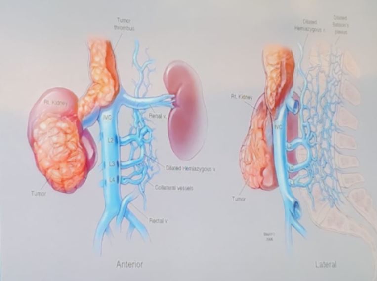 SIU 2019 altered venous anatomy