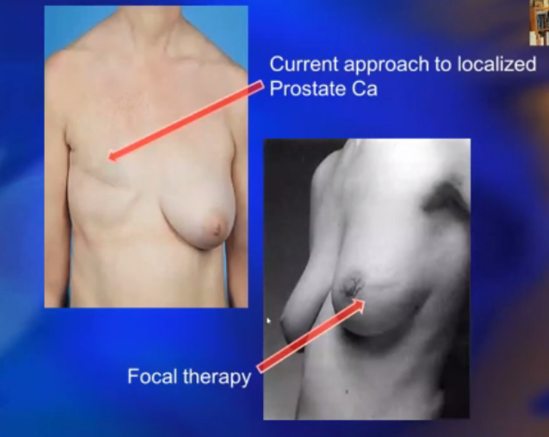 SUO-AUA2020_Focal_Therapy_2.png