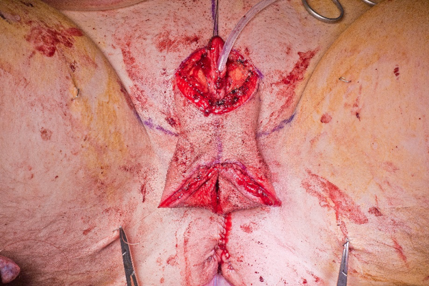 Scrotoplasty_labia_majora_flaps.png