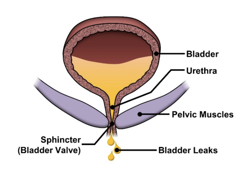 Stop_Bladder_Leaks.png