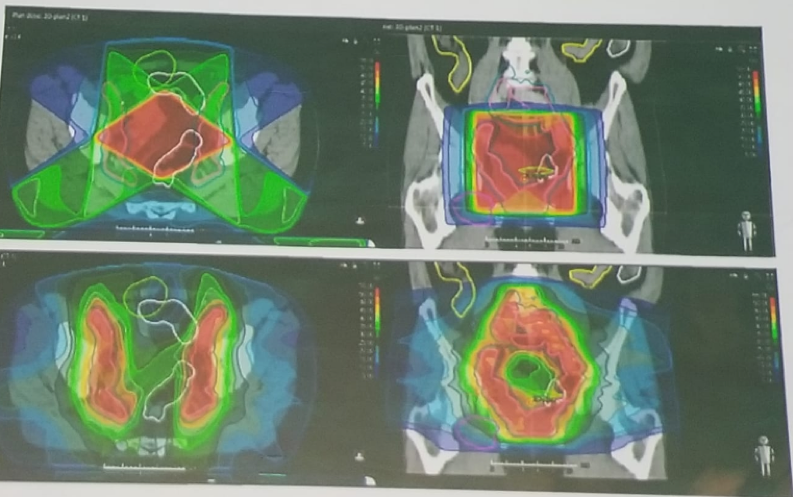 UroToday 3rd Bladder Congress Accurate radiotherapy avoiding the associated toxicity