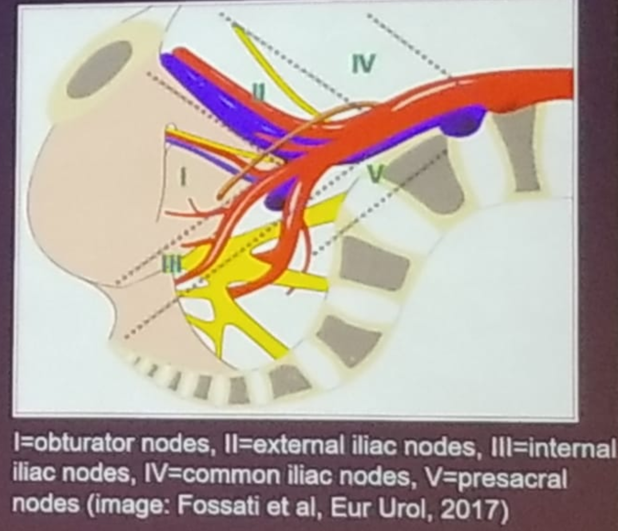 UroToday_ASCOGU2019-Extended pelvic lymph node dissection.png