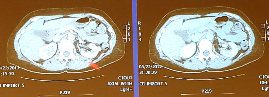 UroToday_ASCOGU2019-Kidney Cancer Case-Based Panel- Localized Disease - 1.png