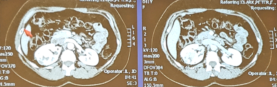UroToday_ASCOGU2019-Kidney Cancer Case-Based Panel- Localized Disease - 2.png