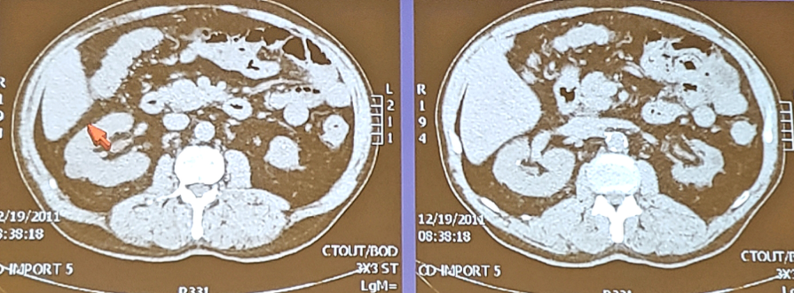 UroToday_ASCOGU2019-Kidney Cancer Case-Based Panel- Localized Disease - 3.png