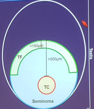 UroToday_ASCOGU2019-Metastatic Seminom.png