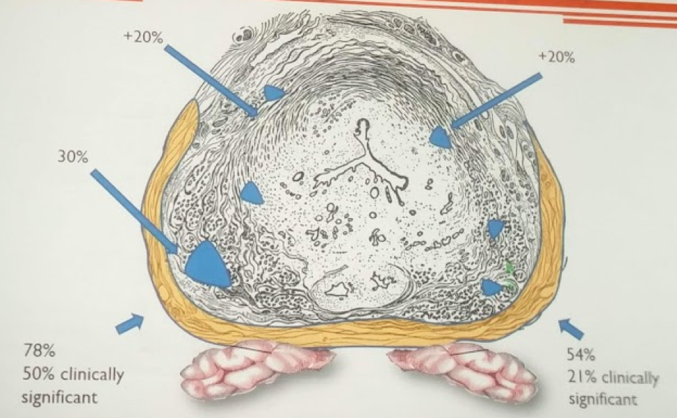 UroToday AUA2018 Evolving Indications for Robotic Prostatectomy