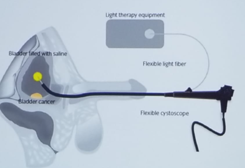 UroToday CUOS19 PDT procedure
