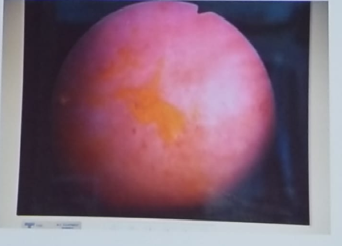 UroToday CUOS19 Preoperative Intravesical Instillation