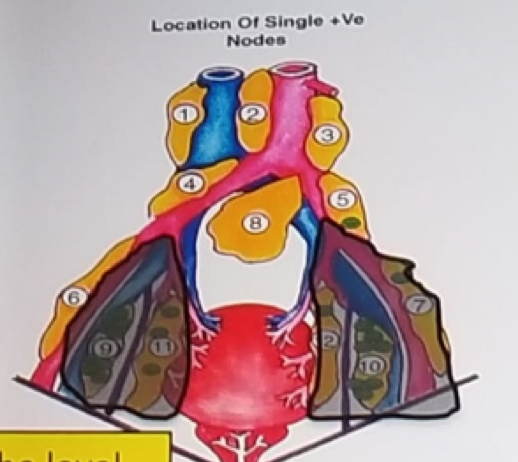 UroToday ERUS2018 Locations of positive lymph nodes