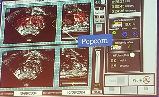 UroToday FOIU2018 HIFU therapy popcorn effect