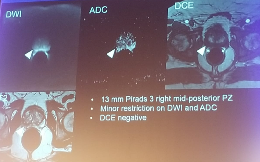 UroToday FOIU2018 Patient prostate MRI