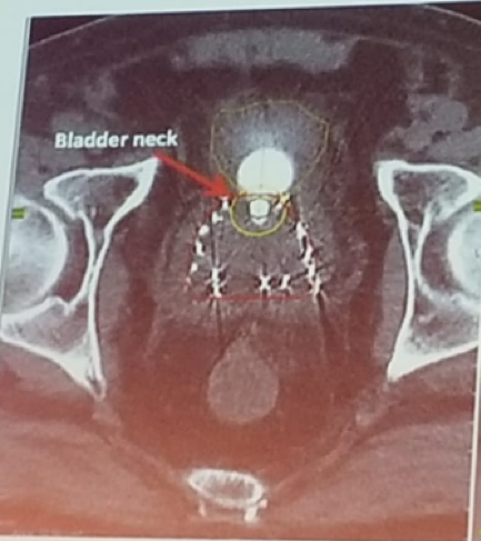 UroToday FOIU2018 Brachytherapy and bladder neck