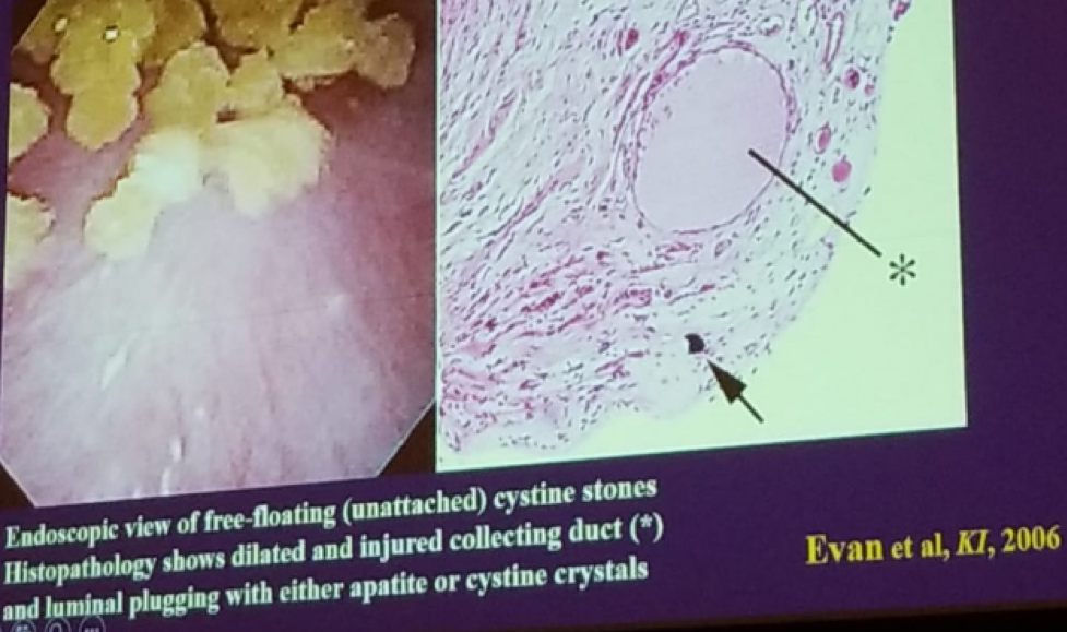 UroToday NSAUA2018 Formation in free solution