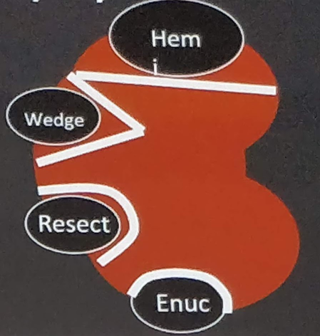 UroToday WCE2018 . Renal tumor excision techniques during