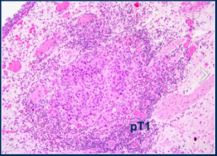 Urothelial_Picture2.png