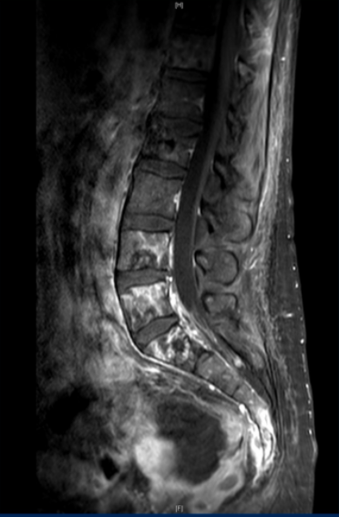 Urothelial_Picture6.png