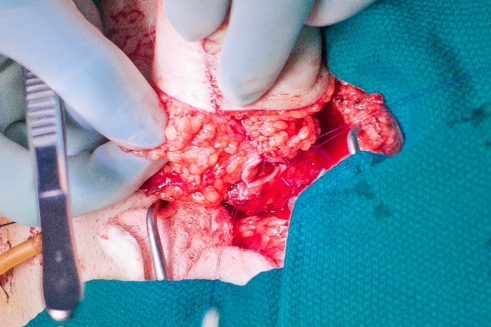 anastomotic_urethroplasty.png
