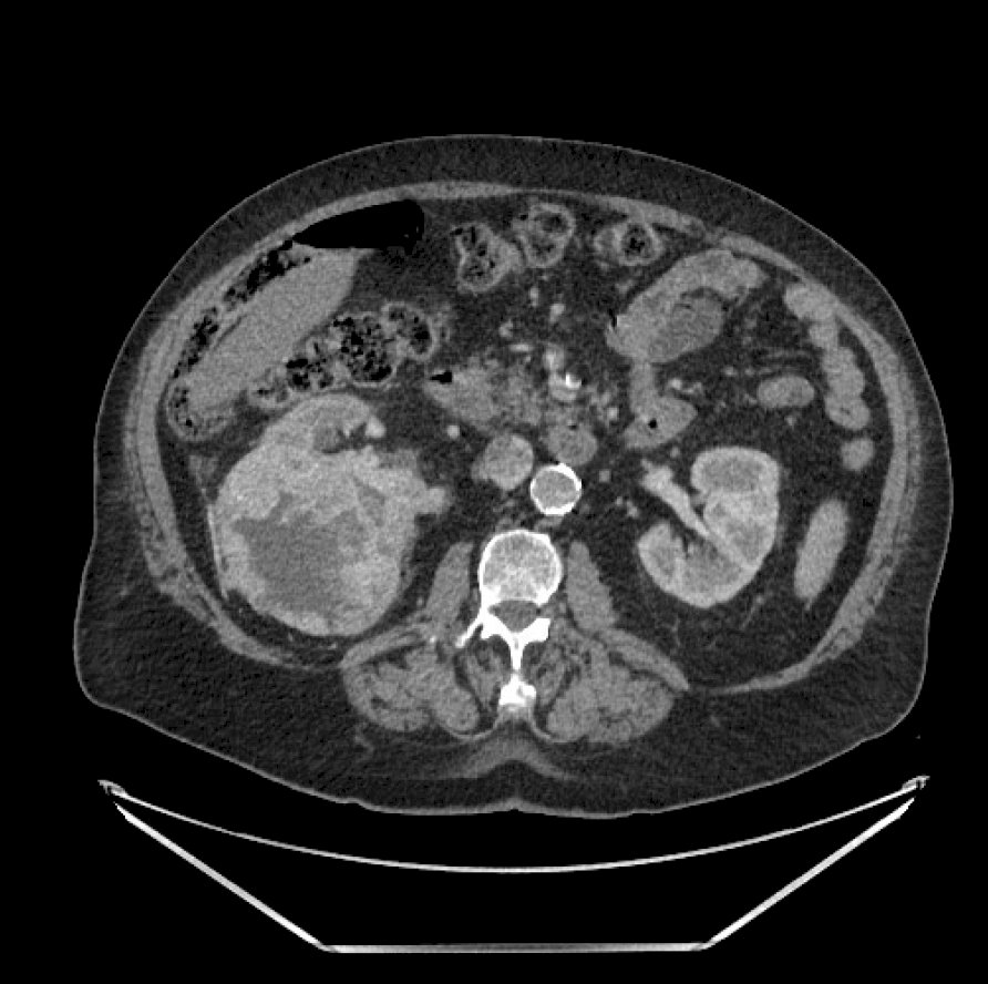 Radiofrequency Ablation.jpg
