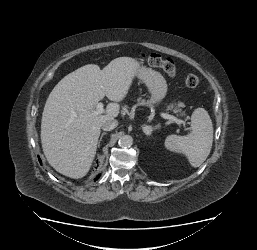 Radiofrequency Ablation-1.jpg