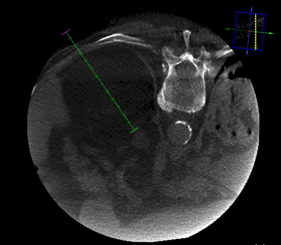 Radiofrequency Ablation-2.jpg