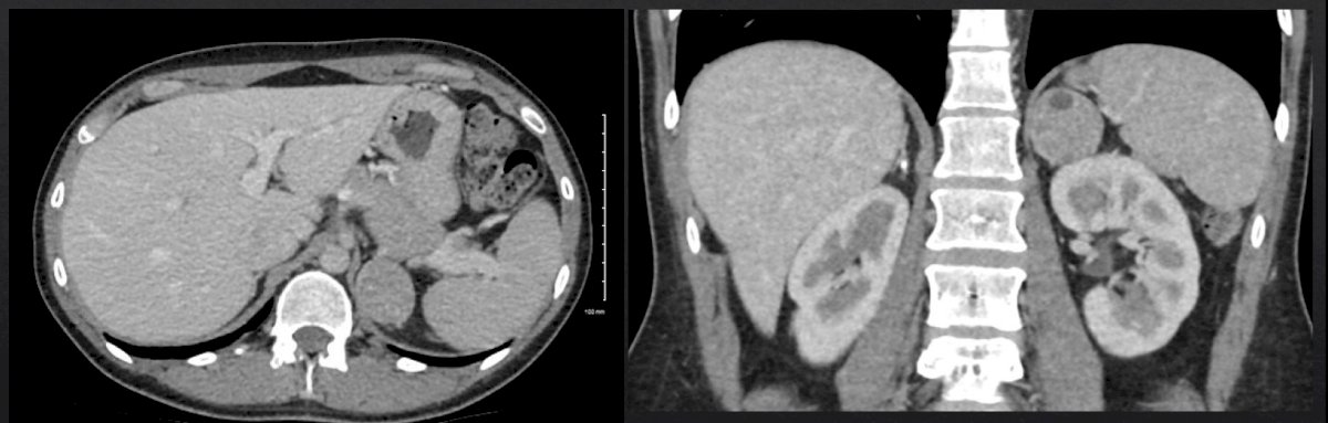 hypercortisolism-2.jpg